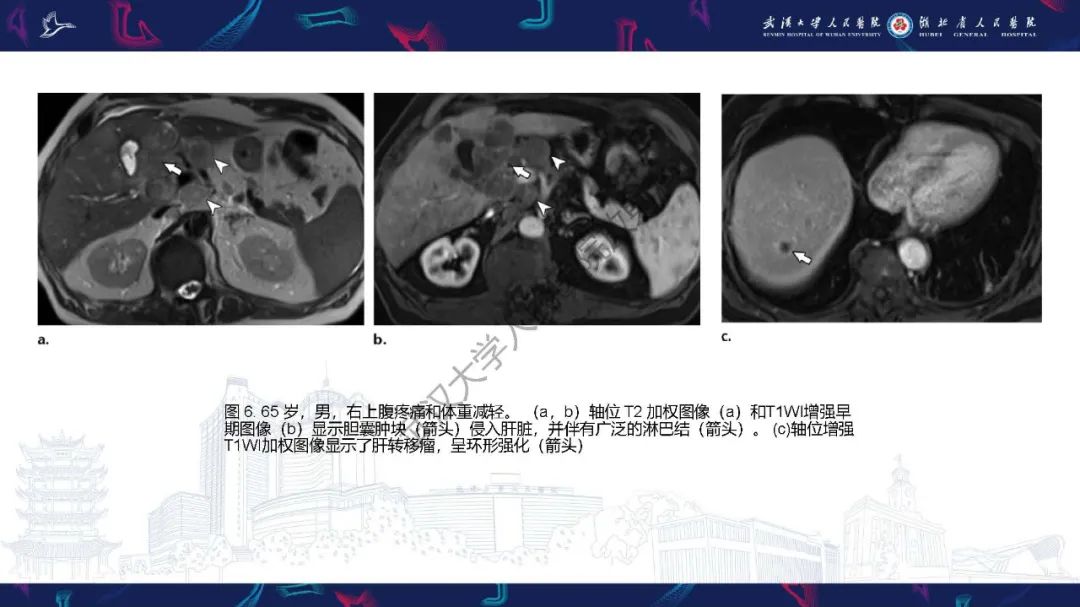 影像PPT - 【PPT】胆囊癌MRI诊断-19