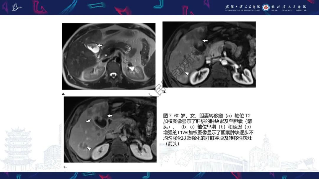 影像PPT - 【PPT】胆囊癌MRI诊断-22