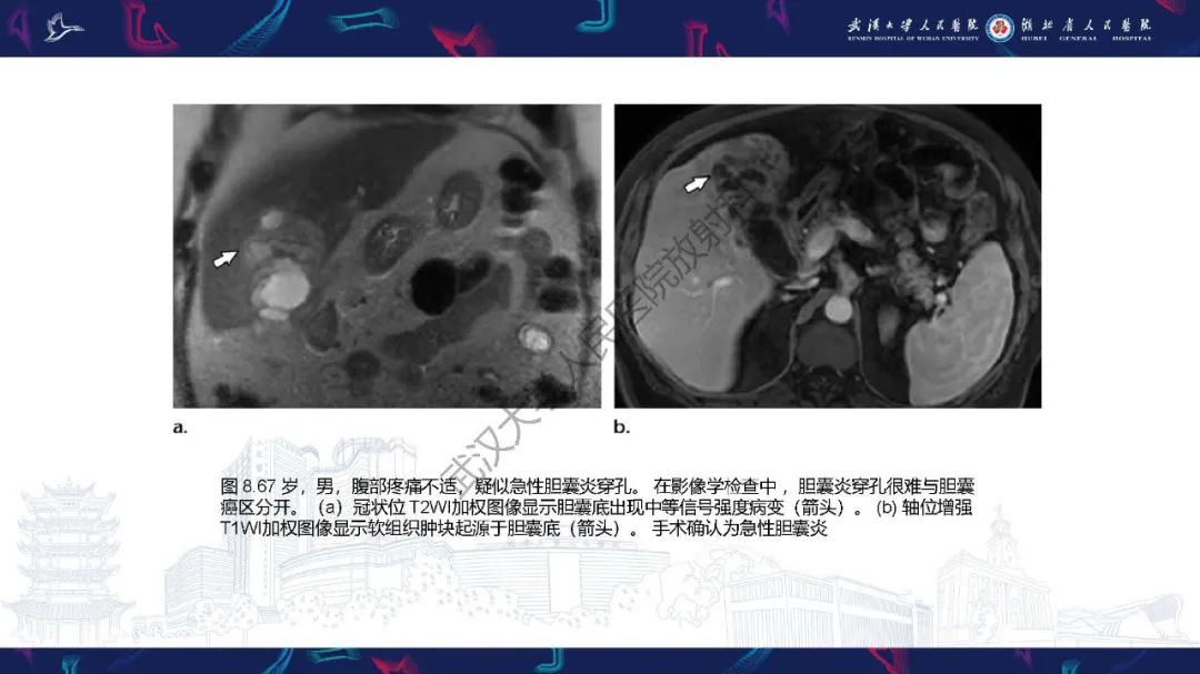 影像PPT - 【PPT】胆囊癌MRI诊断-23