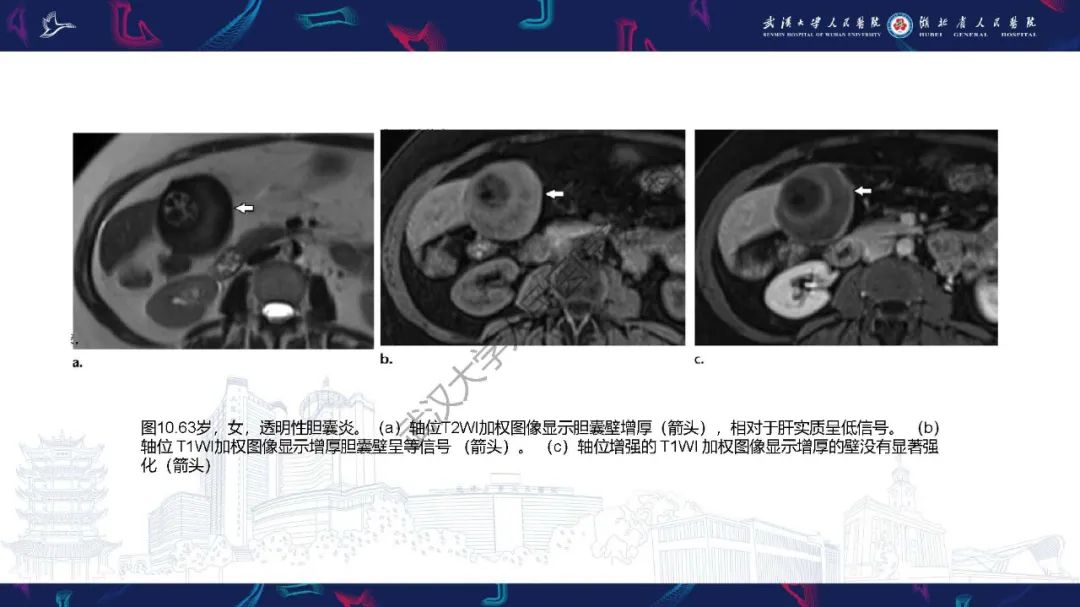 影像PPT - 【PPT】胆囊癌MRI诊断-28