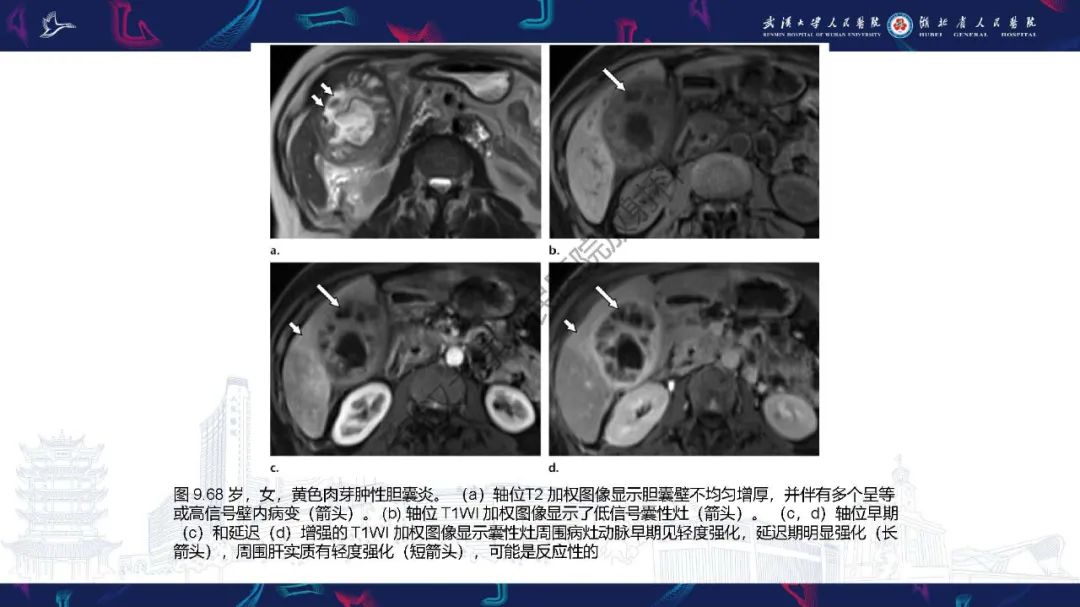 影像PPT - 【PPT】胆囊癌MRI诊断-27