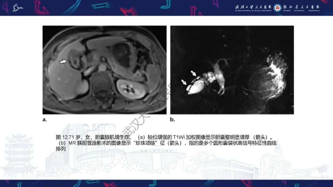 影像PPT - 【PPT】胆囊癌MRI诊断-31