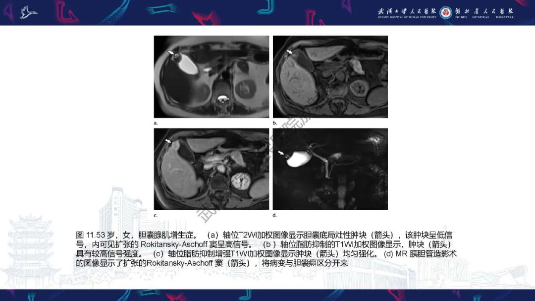 影像PPT - 【PPT】胆囊癌MRI诊断-30