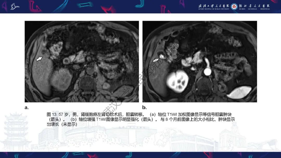 影像PPT - 【PPT】胆囊癌MRI诊断-34