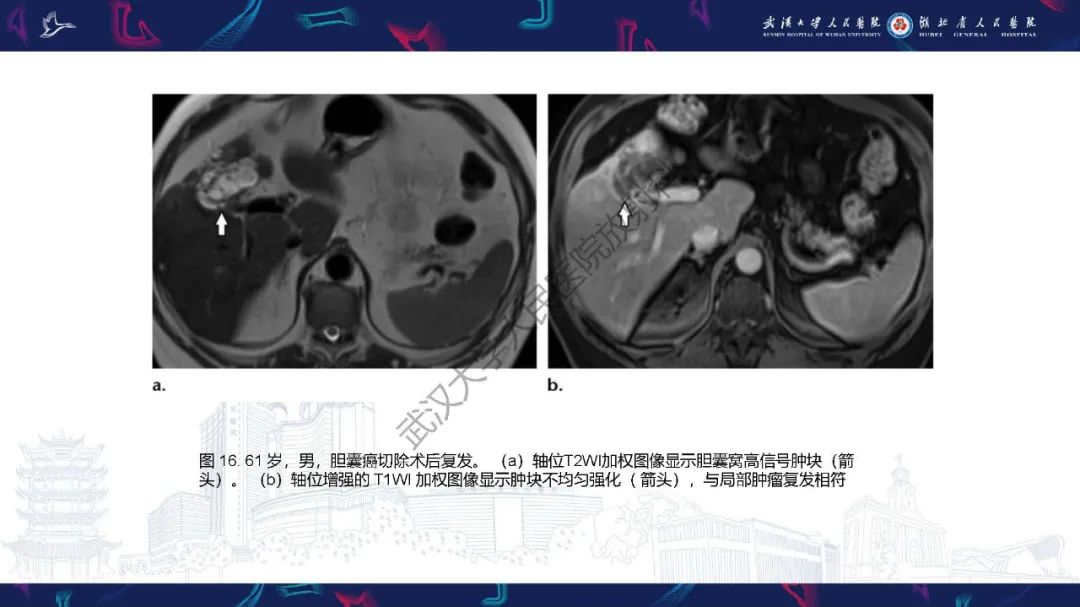 影像PPT - 【PPT】胆囊癌MRI诊断-38