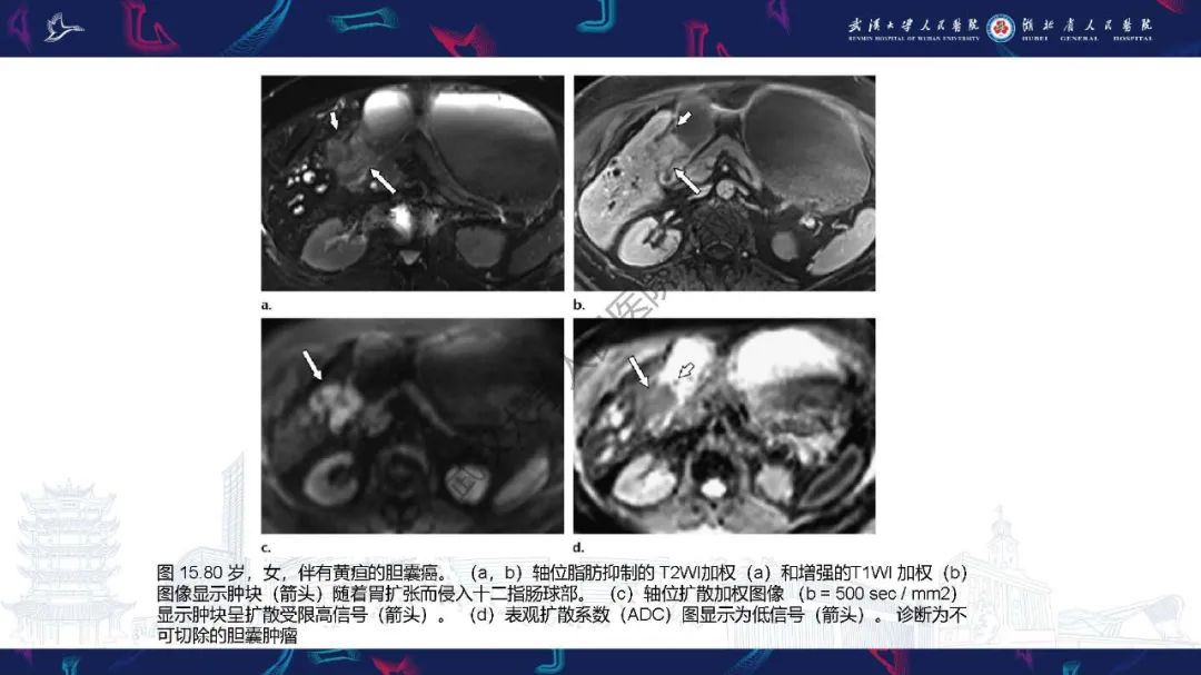 影像PPT - 【PPT】胆囊癌MRI诊断-37