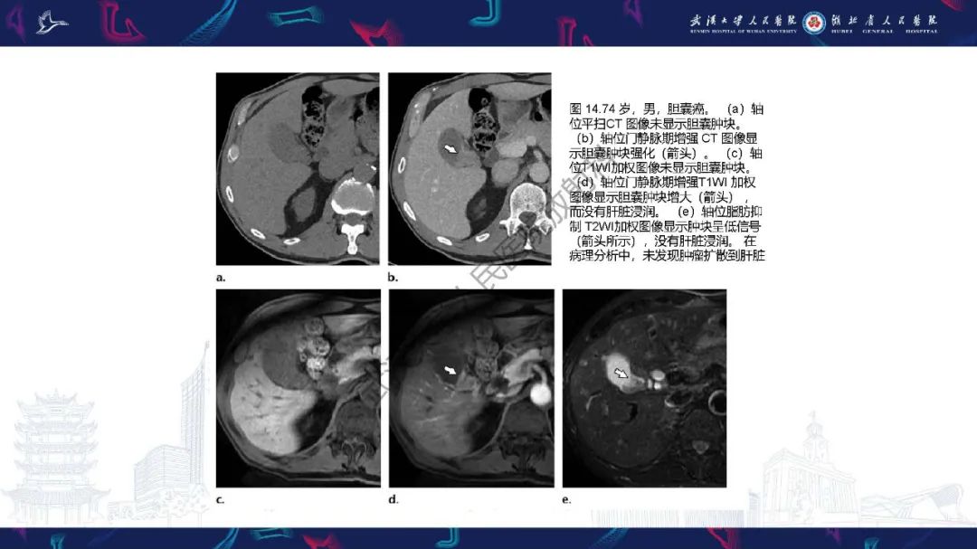 影像PPT - 【PPT】胆囊癌MRI诊断-36