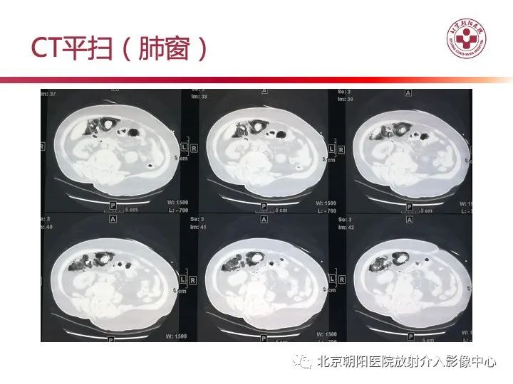 影像PPT - 【PPT】肠壁气肿/肠壁积气-5