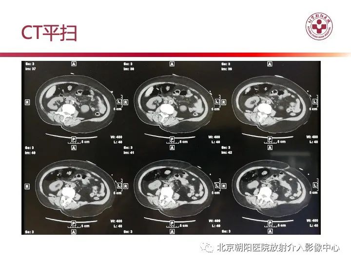 影像PPT - 【PPT】肠壁气肿/肠壁积气-3