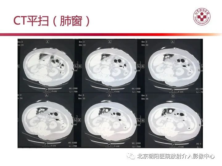 影像PPT - 【PPT】肠壁气肿/肠壁积气-4