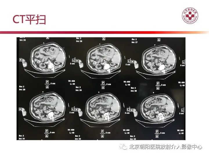 影像PPT - 【PPT】肠壁气肿/肠壁积气-8