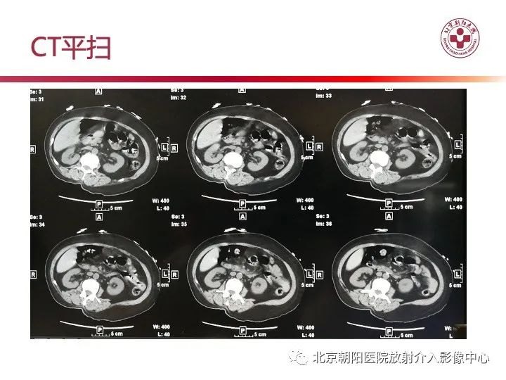 影像PPT - 【PPT】肠壁气肿/肠壁积气-2