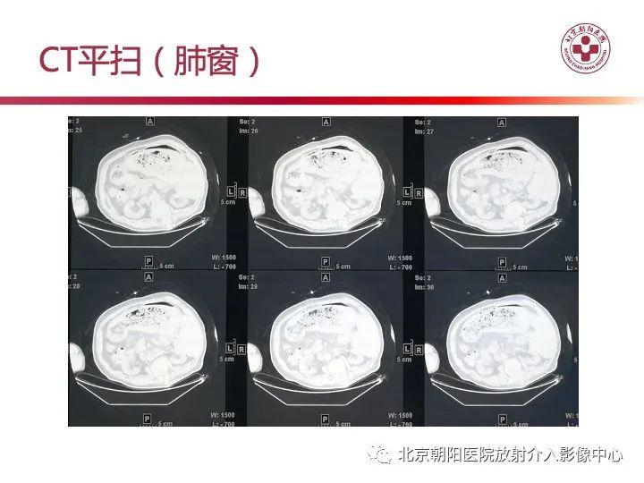 影像PPT - 【PPT】肠壁气肿/肠壁积气-9