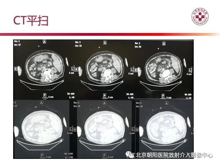 影像PPT - 【PPT】肠壁气肿/肠壁积气-10