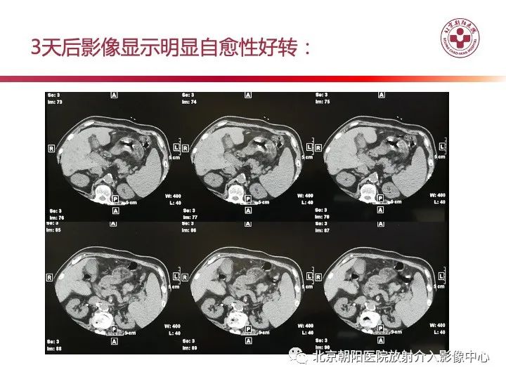 影像PPT - 【PPT】肠壁气肿/肠壁积气-11