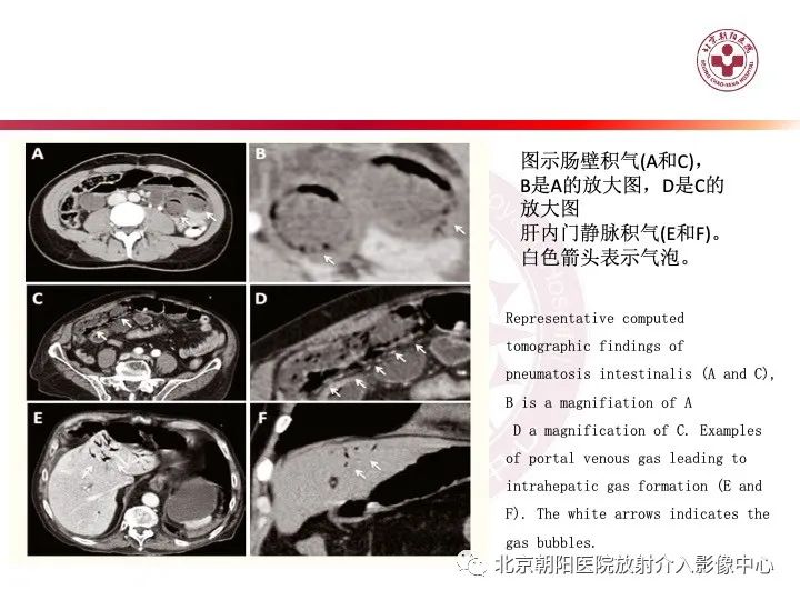 影像PPT - 【PPT】肠壁气肿/肠壁积气-29