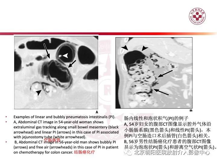 影像PPT - 【PPT】肠壁气肿/肠壁积气-30