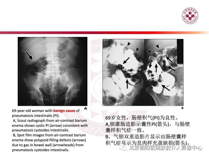 影像PPT - 【PPT】肠壁气肿/肠壁积气-31