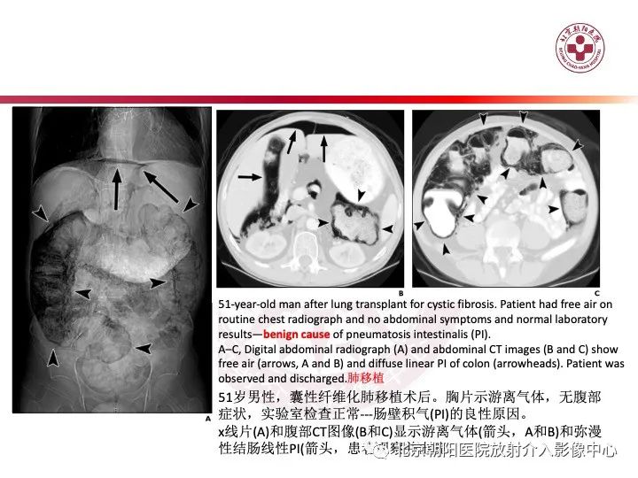 影像PPT - 【PPT】肠壁气肿/肠壁积气-32