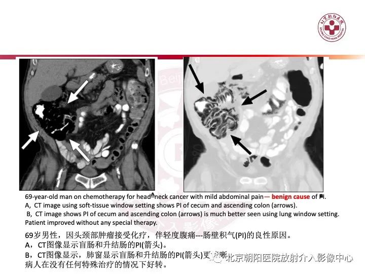影像PPT - 【PPT】肠壁气肿/肠壁积气-33