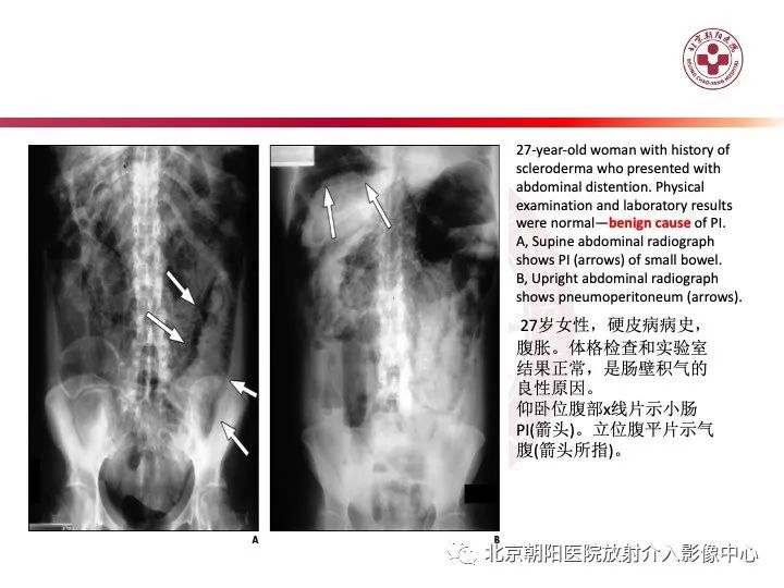影像PPT - 【PPT】肠壁气肿/肠壁积气-34