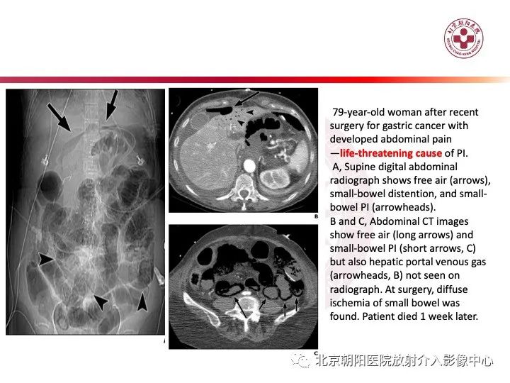 影像PPT - 【PPT】肠壁气肿/肠壁积气-35