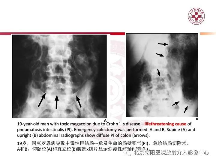 影像PPT - 【PPT】肠壁气肿/肠壁积气-36