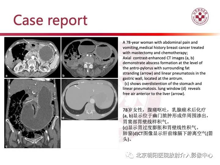 影像PPT - 【PPT】肠壁气肿/肠壁积气-38