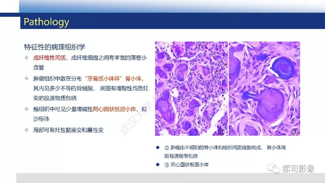 影像PPT - 【PPT】颅底沙瘤样骨化纤维瘤影像诊断-9