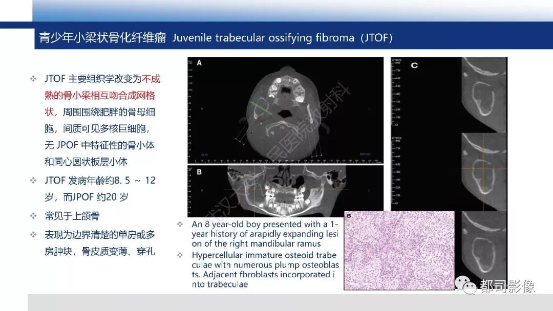 影像PPT - 【PPT】颅底沙瘤样骨化纤维瘤影像诊断-18
