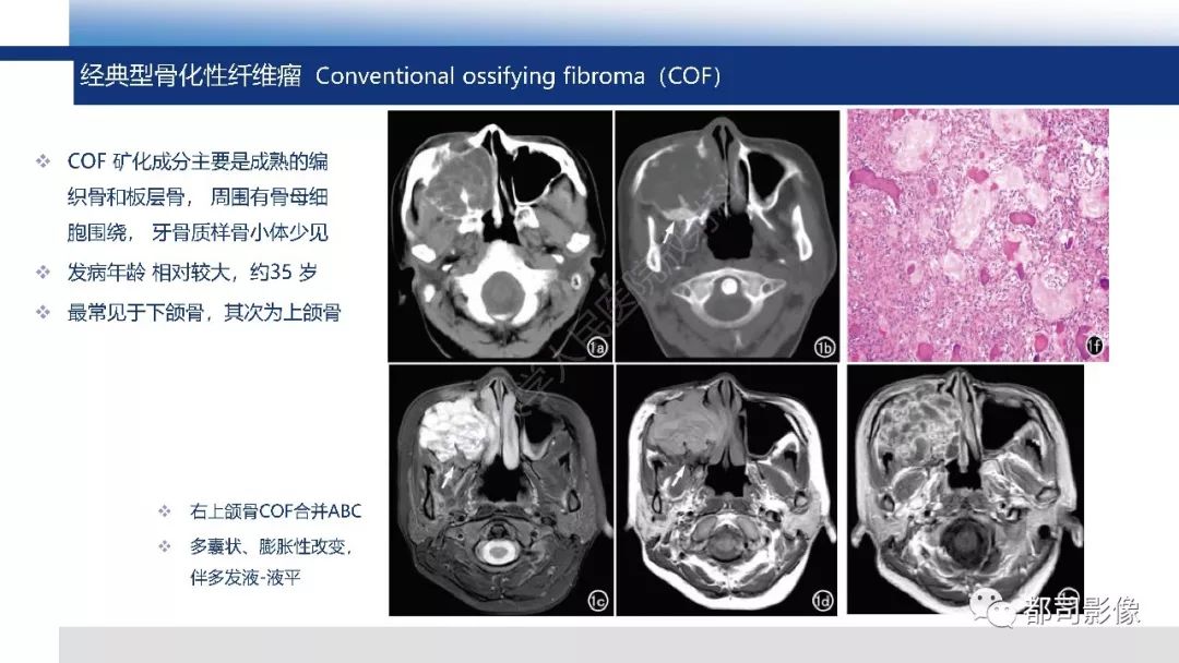影像PPT - 【PPT】颅底沙瘤样骨化纤维瘤影像诊断-17
