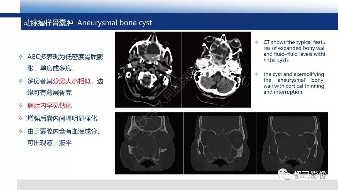 影像PPT - 【PPT】颅底沙瘤样骨化纤维瘤影像诊断-19