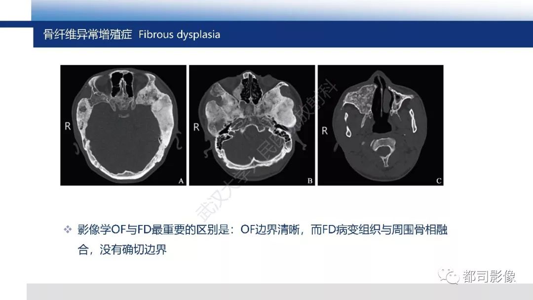影像PPT - 【PPT】颅底沙瘤样骨化纤维瘤影像诊断-20