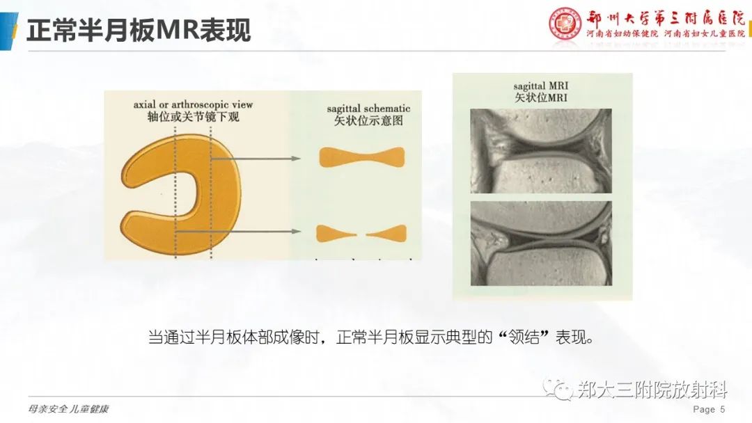 影像PPT - 【PPT】膝关节半月板病变的影像学表现-5