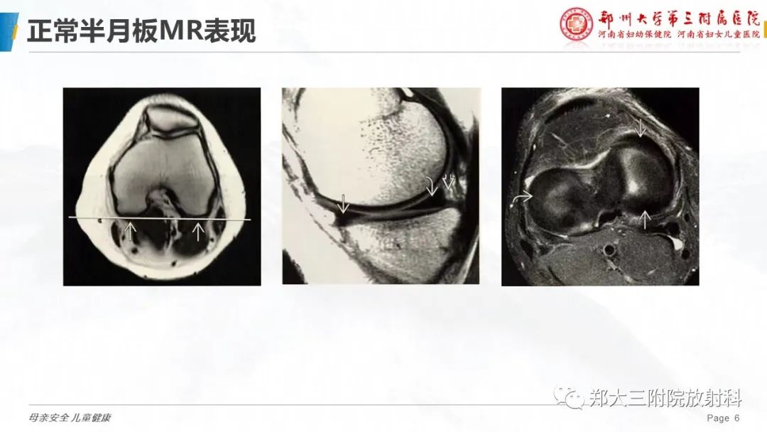 影像PPT - 【PPT】膝关节半月板病变的影像学表现-6