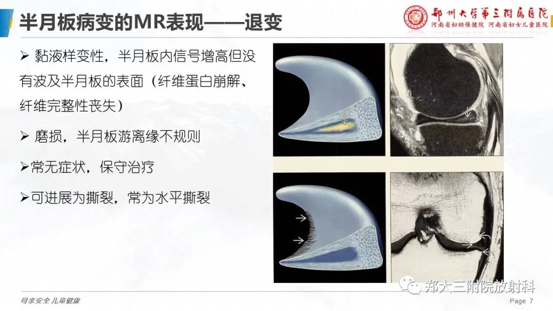影像PPT - 【PPT】膝关节半月板病变的影像学表现-7