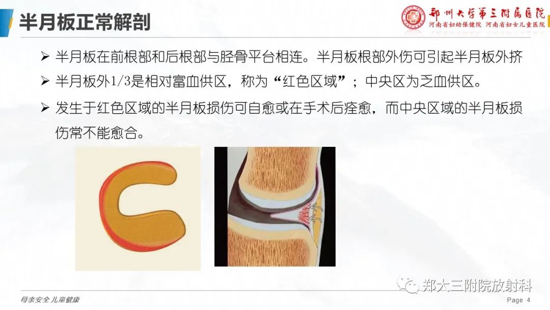 影像PPT - 【PPT】膝关节半月板病变的影像学表现-4