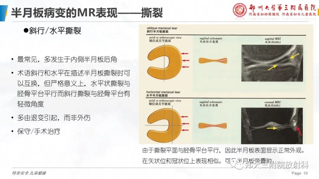 影像PPT - 【PPT】膝关节半月板病变的影像学表现-10