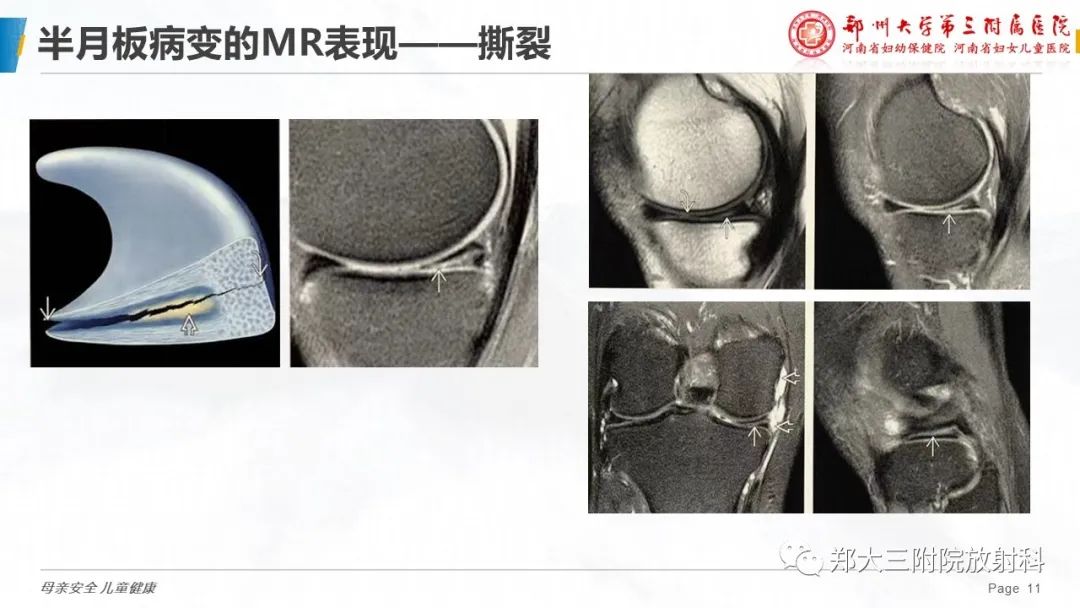 影像PPT - 【PPT】膝关节半月板病变的影像学表现-11