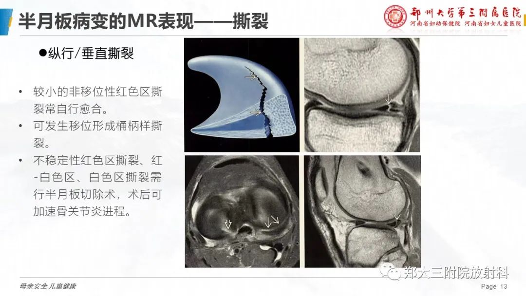 影像PPT - 【PPT】膝关节半月板病变的影像学表现-13
