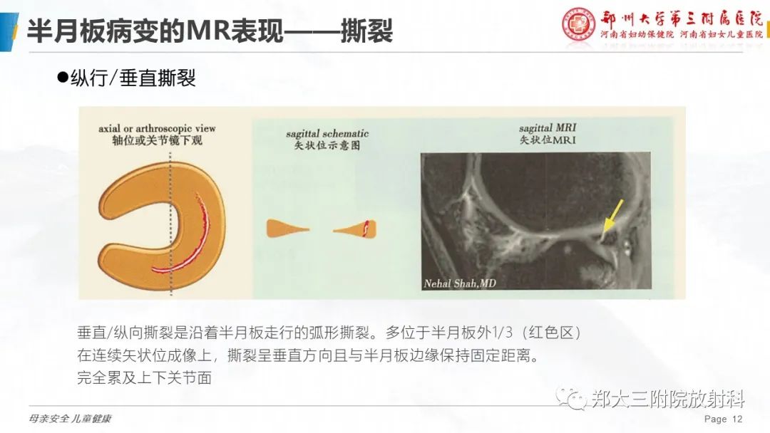 影像PPT - 【PPT】膝关节半月板病变的影像学表现-12