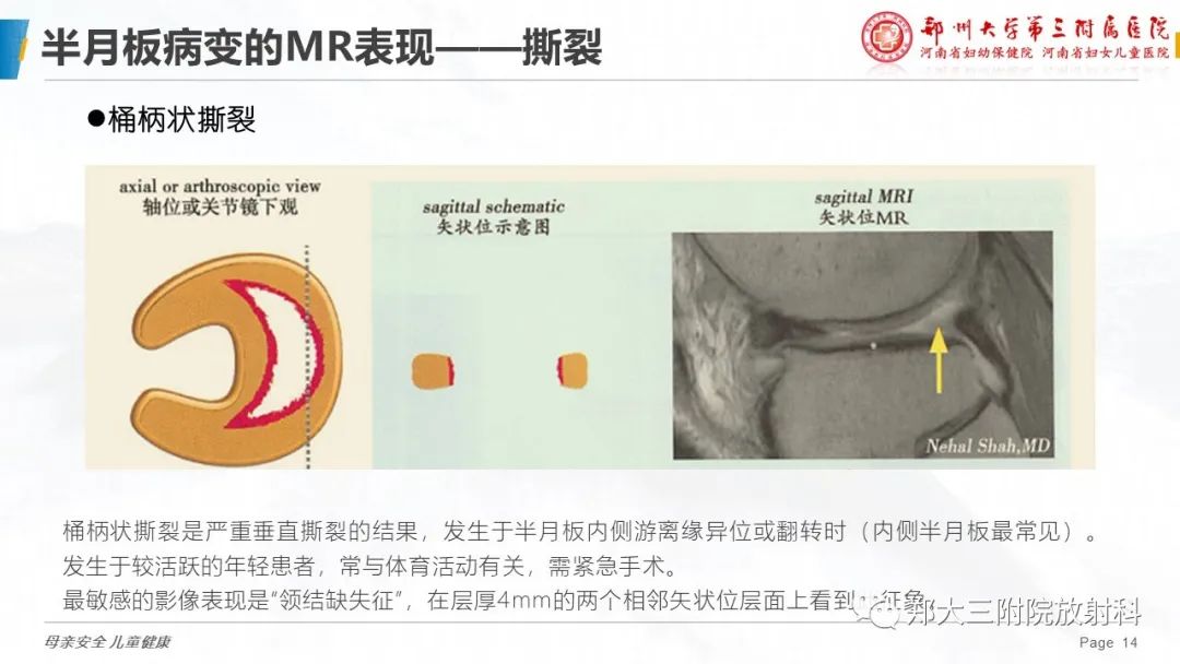 影像PPT - 【PPT】膝关节半月板病变的影像学表现-14