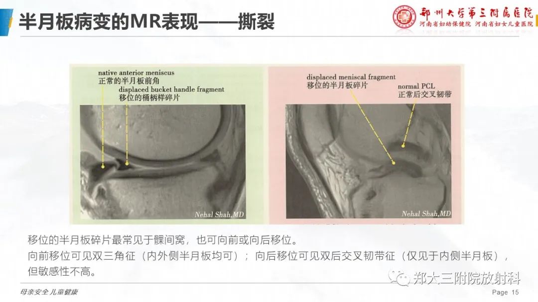 影像PPT - 【PPT】膝关节半月板病变的影像学表现-15