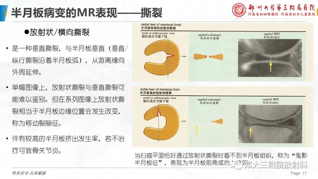 影像PPT - 【PPT】膝关节半月板病变的影像学表现-17