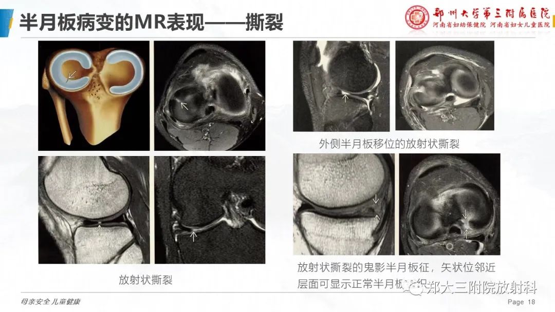 影像PPT - 【PPT】膝关节半月板病变的影像学表现-18