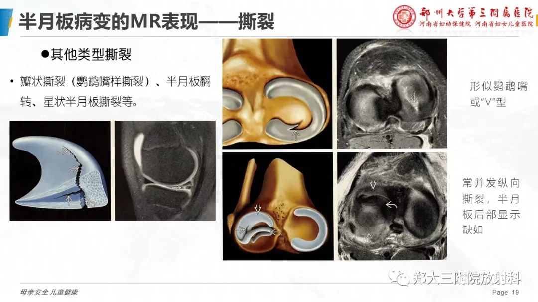 影像PPT - 【PPT】膝关节半月板病变的影像学表现-19