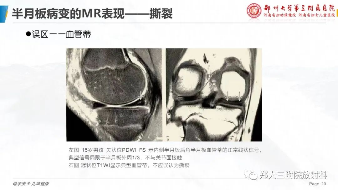 影像PPT - 【PPT】膝关节半月板病变的影像学表现-20