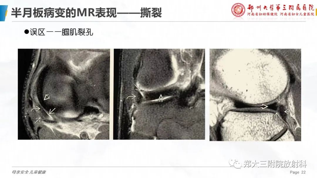 影像PPT - 【PPT】膝关节半月板病变的影像学表现-22