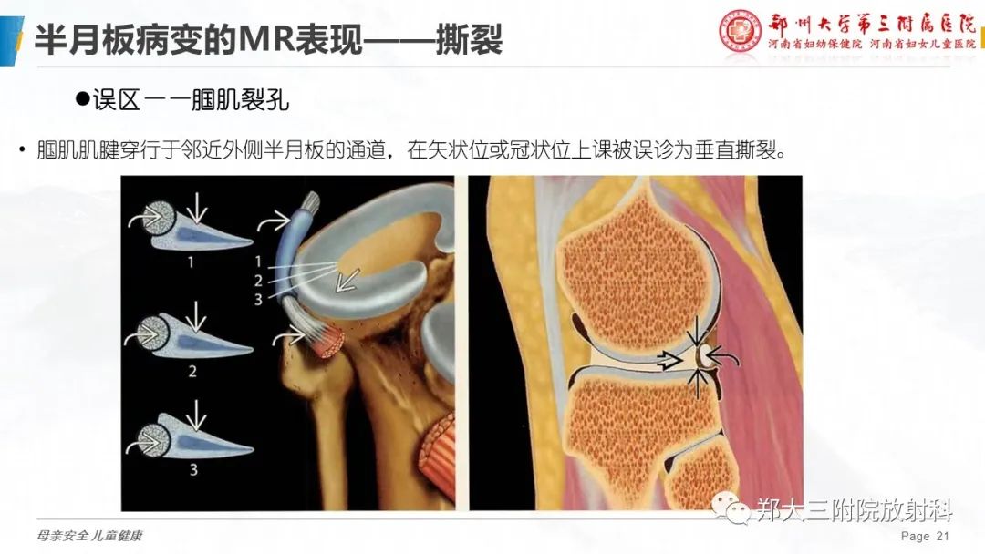 影像PPT - 【PPT】膝关节半月板病变的影像学表现-21