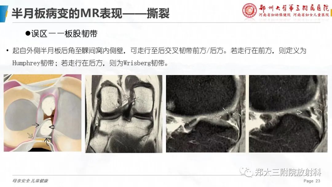 影像PPT - 【PPT】膝关节半月板病变的影像学表现-23